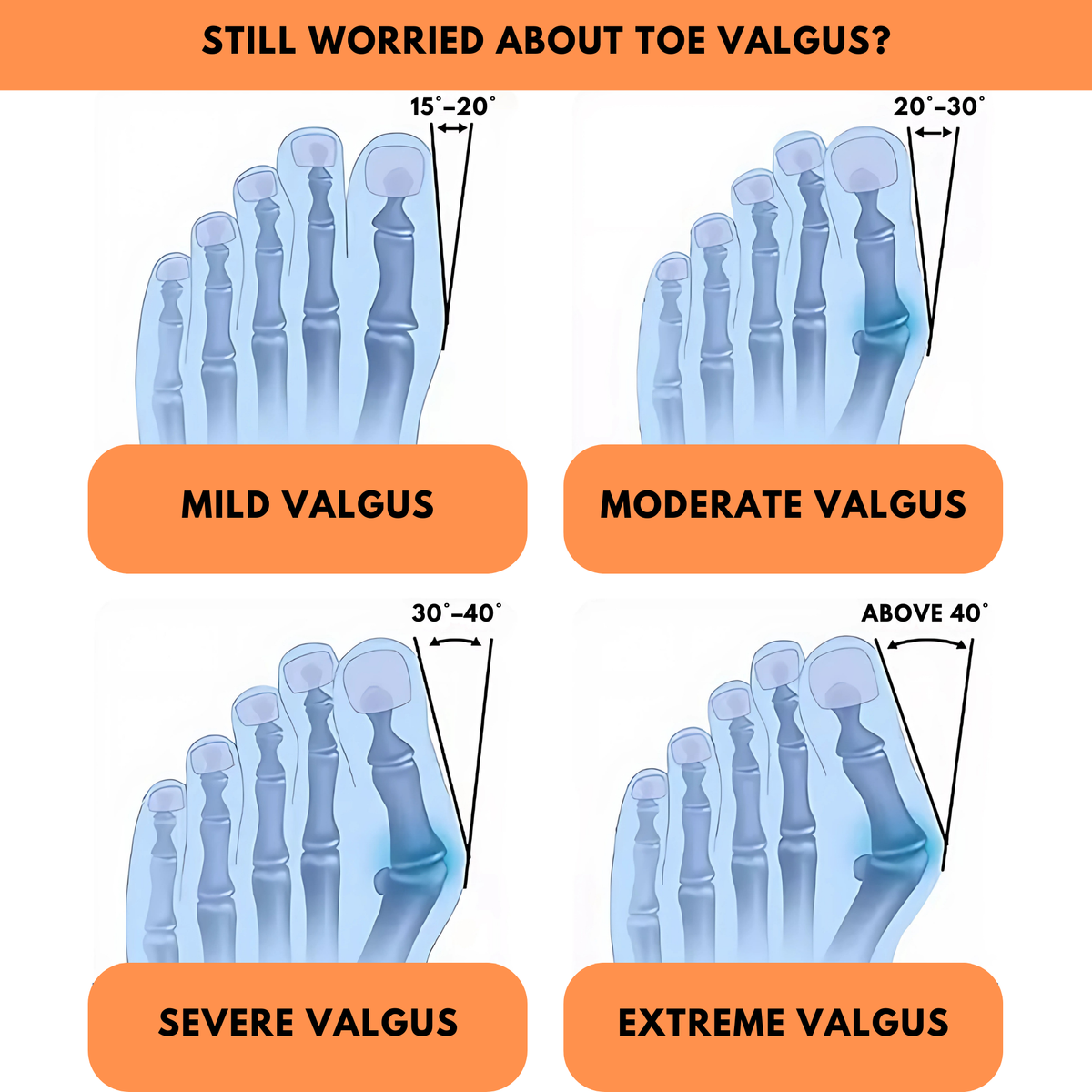Stryde Silicone Bunion Toe Corrector