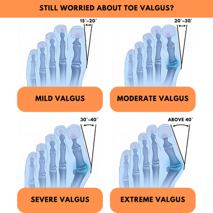 Stryde Silicone Bunion Toe Corrector